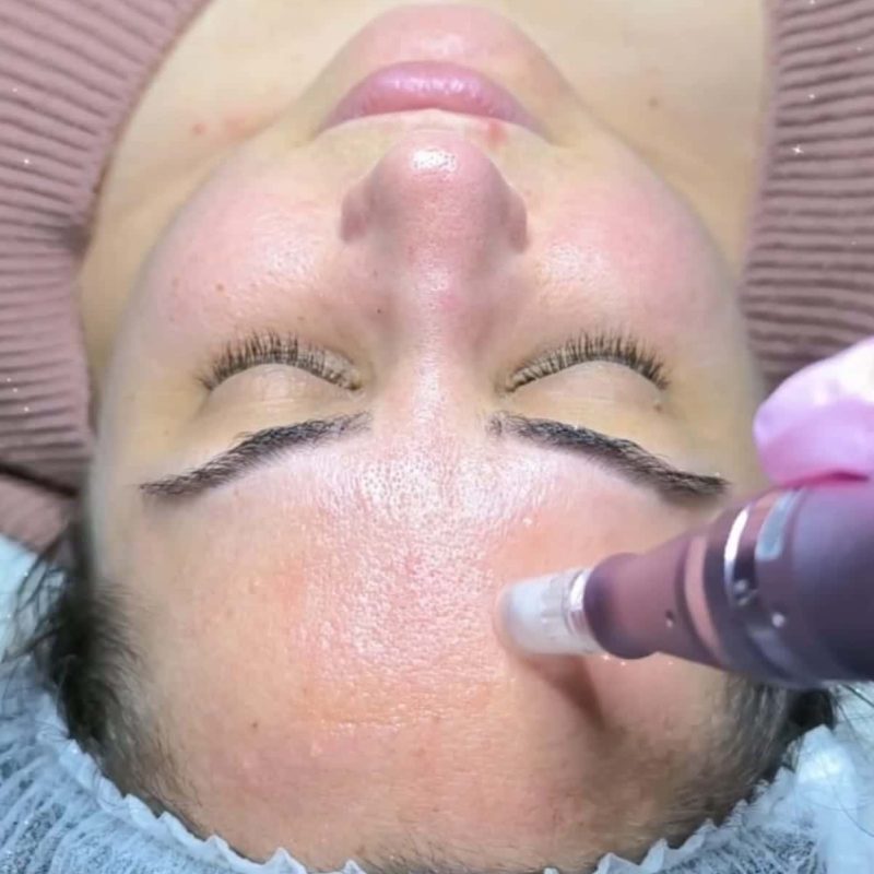 Tratamiento antiaging con migroneedling