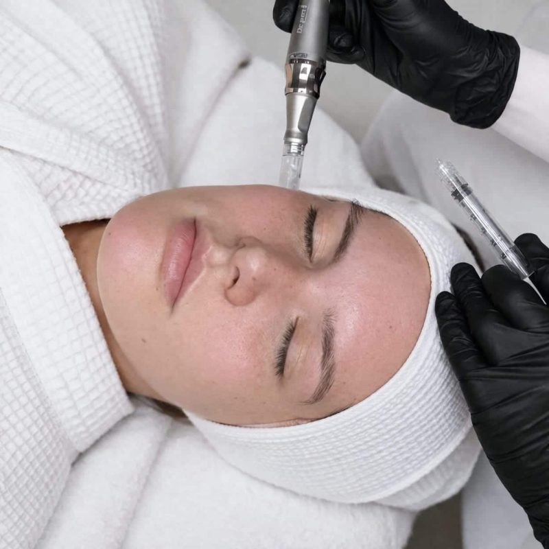 Tratamiento luminosidad dermapen