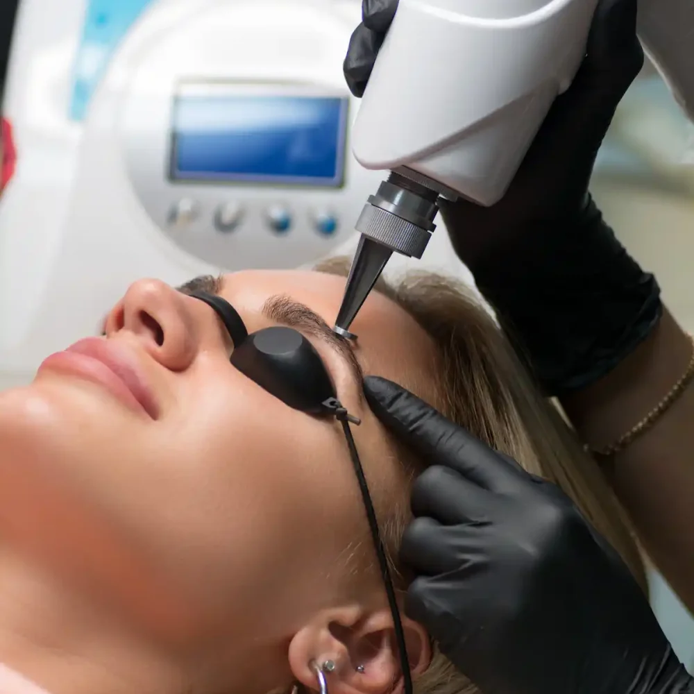 eliminacion de micropigmentacion en cejas