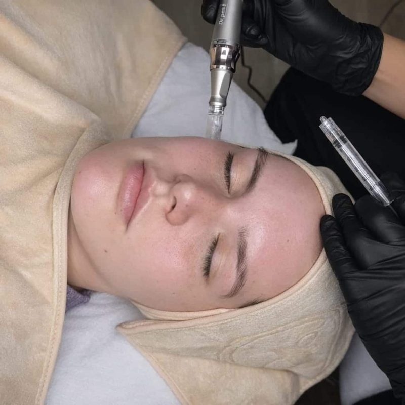 tratamiento luminosidad dermapen